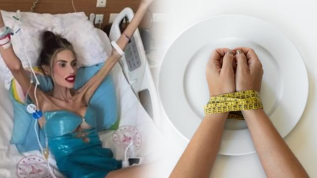 Aç kalma hastalığı değil, ölümcül bir psikolojik rahatsızlık! Anoreksiya nevroza nedir? Anoreksiya nasıl tedavi edilir?