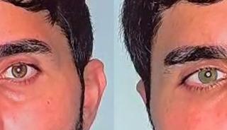 Göz renginizi değiştirmek artık mümkün