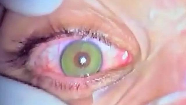 Göz renginizi kalıcı olarak değiştirmek artık mümkün: Yeşil ve mavi tonları, en çok talep edilen renkler arasında