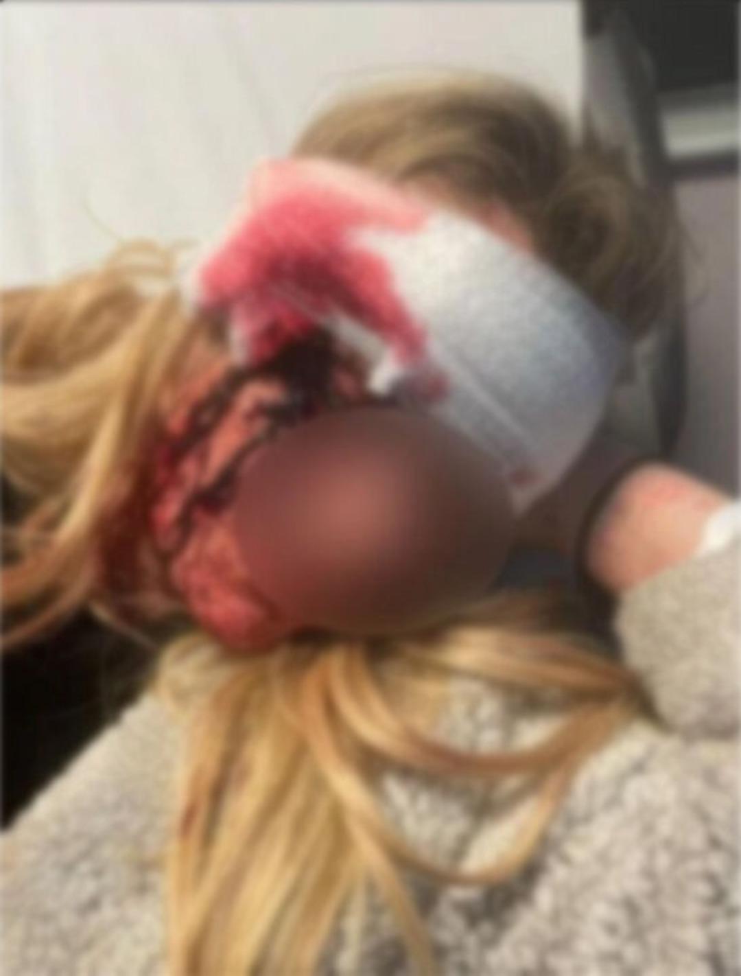 Kan donduran olay! Kız arkadaşının kaşını koparttı! Genç kadına yapmadığını bırakmamış! Yatak odasına sürükleyip... 2