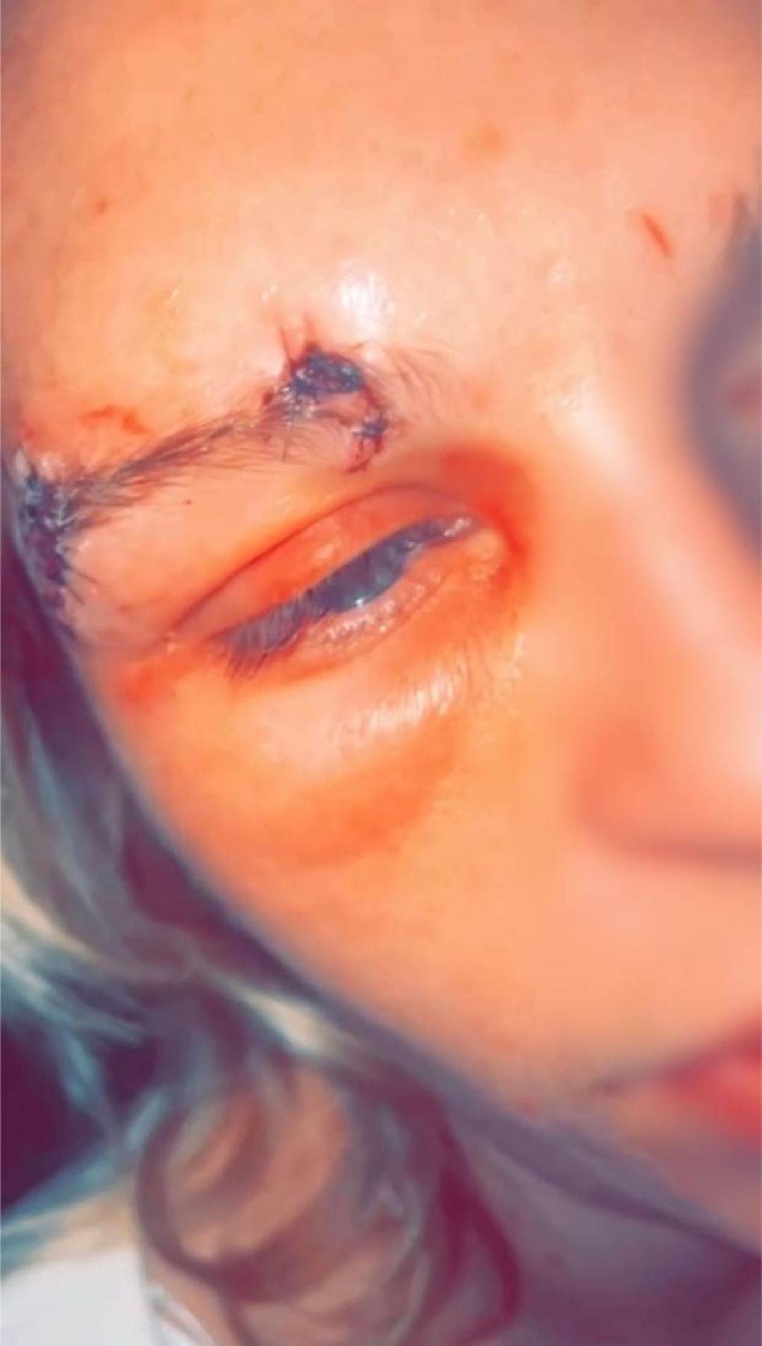 Kan donduran olay! Kız arkadaşının kaşını koparttı! Genç kadına yapmadığını bırakmamış! Yatak odasına sürükleyip... 3