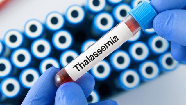 Talasemi nedir? Talasemi belirtileri ve tedavisi