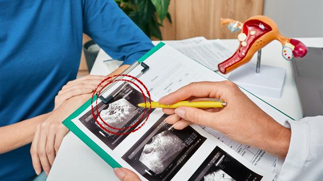Anne olmak isteyenler bu önemli: Rahim poliplerine dikkat! Kadınların yarısında belirti vermeden ilerliyor: Tüp bebek tedavilerini etkiliyor