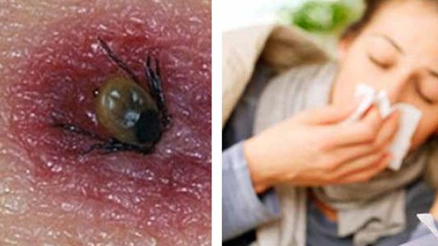 Grip ile karıştırmayın: Ölümcül kene ısırığına dikkat! Bu belirtileri göz ardı etmeyin! Özellikle o bölgedekiler risk altında...