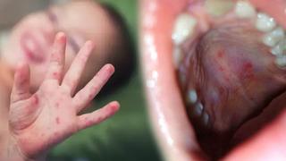 Aileler dikkat! Çocuklar arasında hızla yayılan salgın: Bu hastalığa dikkat: El, ayak ve ağız hastalığı çok hızlı bulaşıyor!