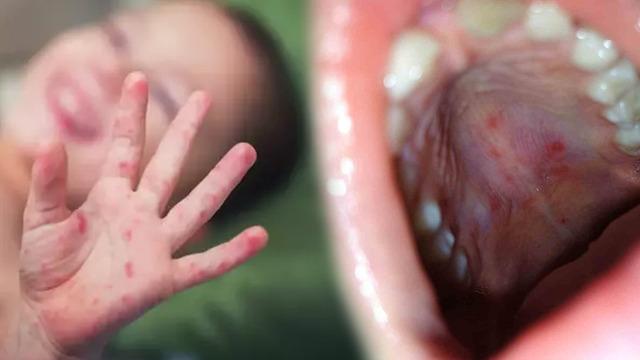 Aileler dikkat! Çocuklar arasında hızla yayılan salgın: Bu hastalığa dikkat: El, ayak ve ağız hastalığı çok hızlı bulaşıyor!