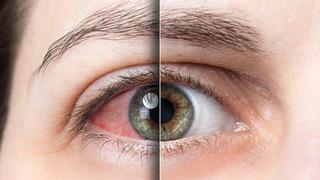 Göz sağlığınızı hafife almayın! Yanma ve batma şikayetlerine son: Kuru göz hastalığı yaşam kalitesini düşürüyor