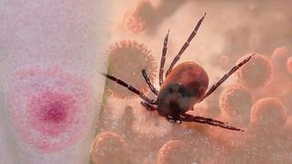 Kenelerden gelen tehlike: Lyme hastalığına yol açıyor: Bu belirtilere dikkat! Uzmanlar uyarıyor: Lyme hastalığı ölümcül seyredebilir