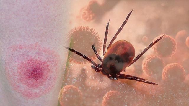 Kenelerden gelen tehlike: Lyme hastalığına yol açıyor: Bu belirtilere dikkat! Uzmanlar uyarıyor: Lyme hastalığı ölümcül seyredebilir