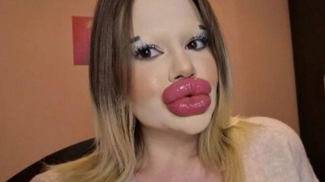 Dünyanın en büyük dudaklarına sahip! Dişi ağrıyınca doktora gitti, aldığı yanıt şoka soktu! Çaresizce çözüm arıyor