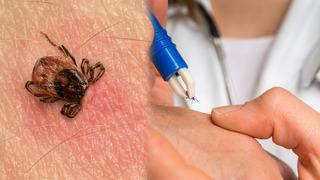 Dikkat! Kene uyarısı: Sigara basmak, kolonya dökmek, ateş tutmak virüsü vücuda bulaştırır Türkiye'de 50'den fazla kene türü var...