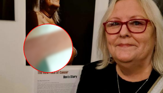 Kanser oldu, göğüsleri maviye döndü! Artık ona 'şirine' diyorlar