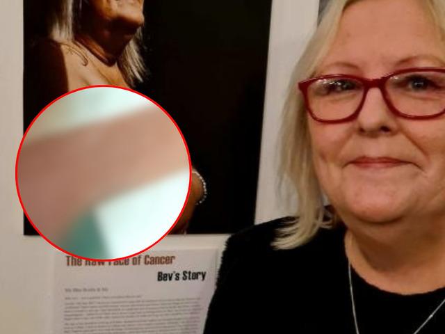 Kanser oldu, göğüsleri maviye döndü! Artık ona 'şirine' diyorlar