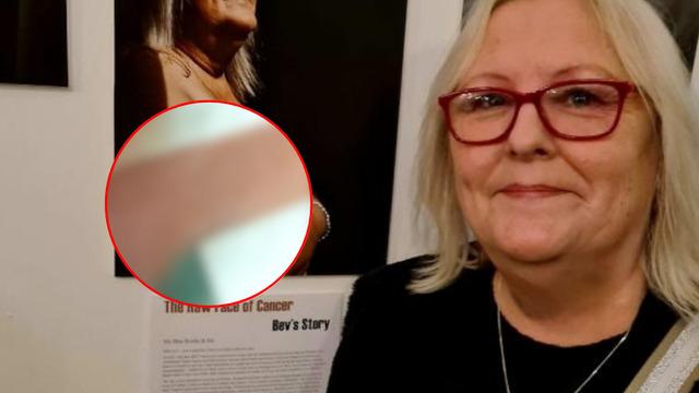 Kanser tedavisinden sonra göğüsleri maviye döndü! Yıllarca geçmedi! Artık ona 'şirine' diyorlar