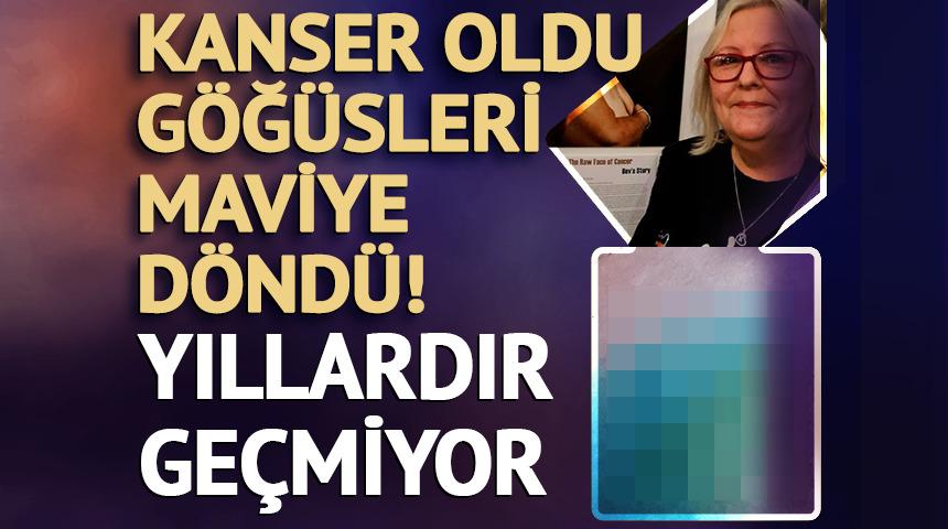 Kanser oldu, göğüsleri maviye döndü! Artık ona 'şirine' diyorlar