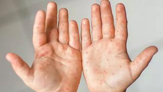 1992'den itibaren en yüksek vaka sayısı! Büyük salgını bile geride bıraktı: 2025’te kızamık vakaları 33 yılın tepesinde! 