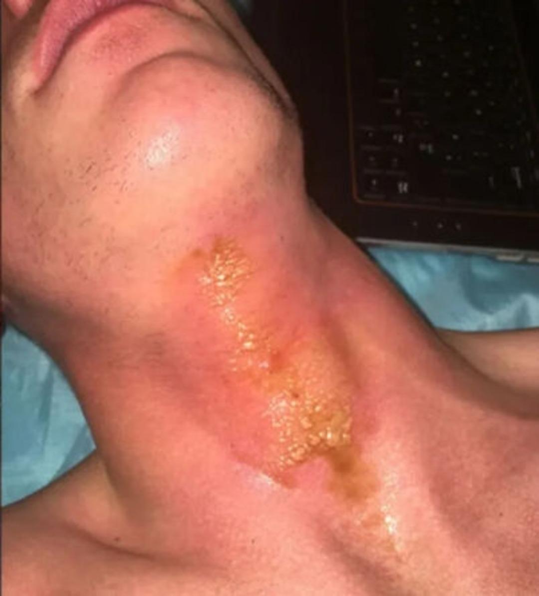 Altın kolye taktı, 5 gün yataktan kalkamadı! Uyandığında hayatının şokunu yaşadı! Derisi yüzülmüş... 1