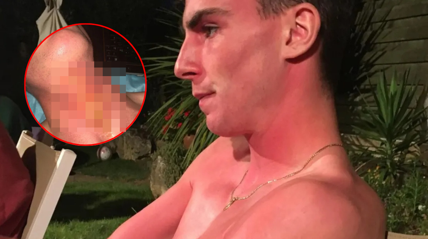 Altın kolye taktı, 5 gün yataktan kalkamadı! Uyandığında hayatının şokunu yaşadı! Derisi yüzülmüş...