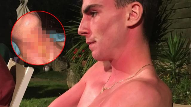 Altın kolye taktı, 5 gün yataktan kalkamadı! Uyandığında hayatının şokunu yaşadı! Derisi yüzülmüş...