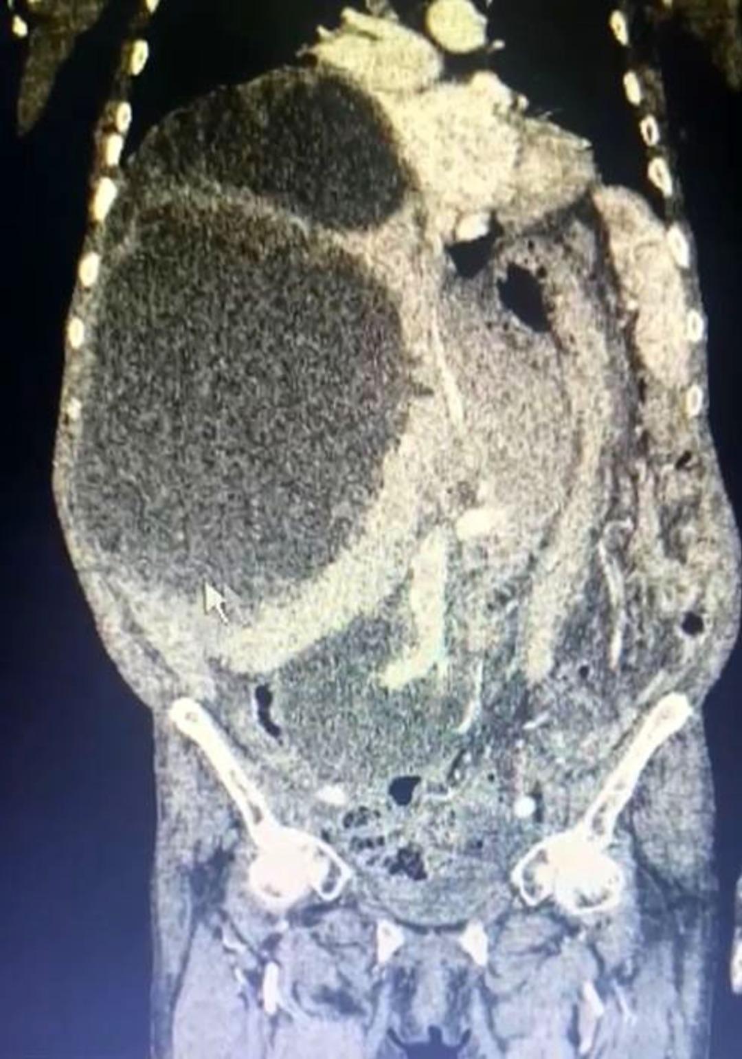 A case that entered world literature: The abdomen and liver were covered in cysts! A cat-dog cyst measuring up to 90 centimeters was removed!
