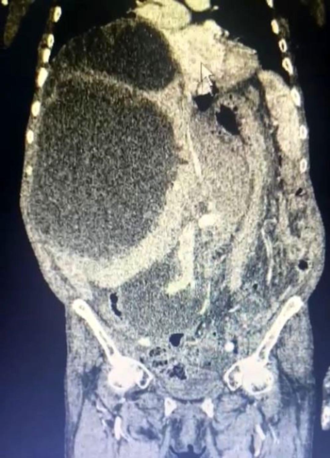 A case that entered world literature: The abdomen and liver were covered in cysts! A cat-dog cyst measuring up to 90 centimeters was removed!