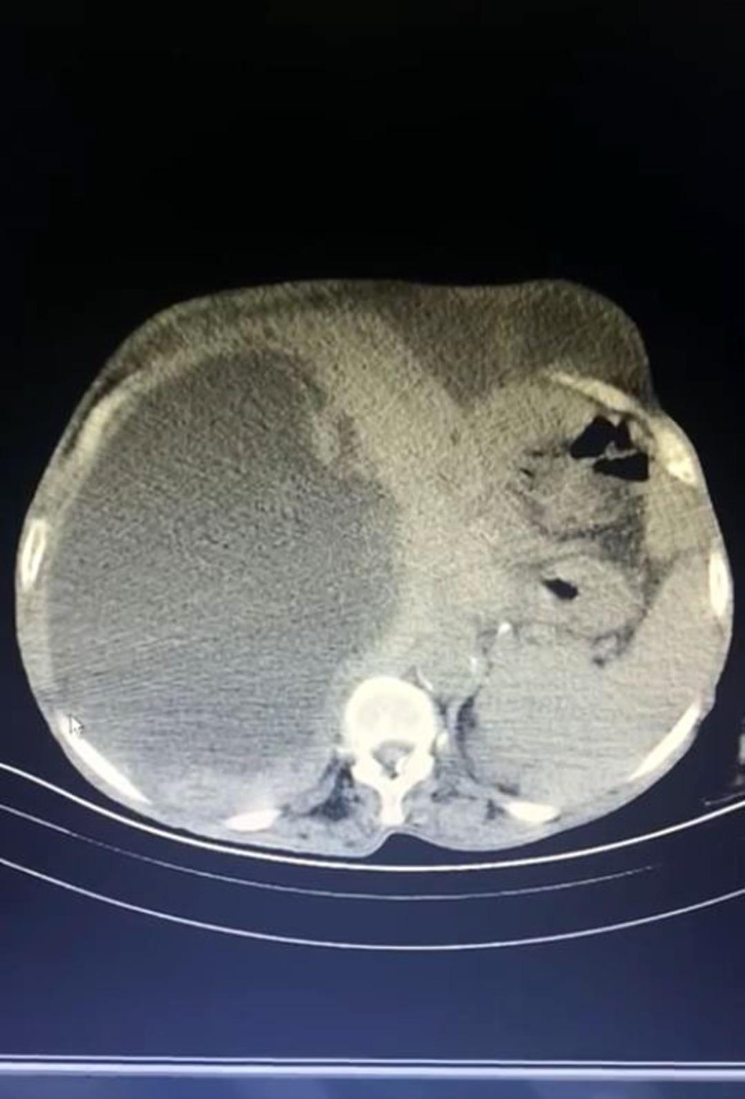 A case that entered world literature: The abdomen and liver were covered in cysts! A cat-dog cyst measuring up to 90 centimeters was removed!