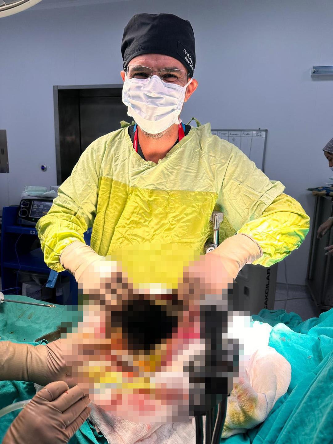 A case that entered world literature: The abdomen and liver were covered in cysts! A cat-dog cyst measuring up to 90 centimeters was removed!