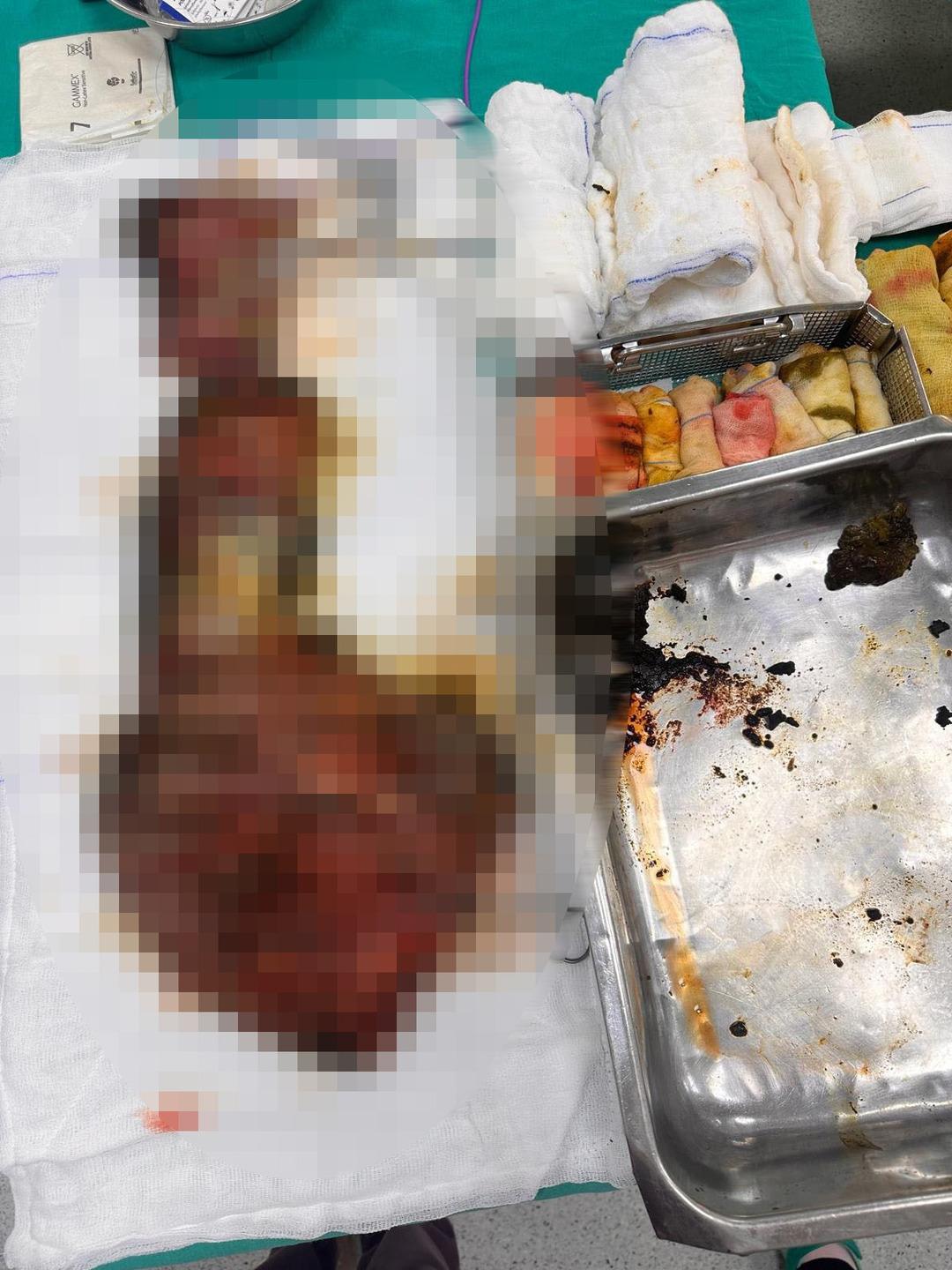 A case that entered world literature: The abdomen and liver were covered in cysts! A cat-dog cyst measuring up to 90 centimeters was removed!