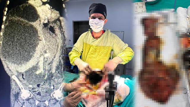 Dünya literatürüne giren vaka: Karnı ve karaciğeri kistle kaplıydı! 90 santimetreye ulaşan kedi-köpek kisti çıkarıldı! Ölümüne sebep olabilir