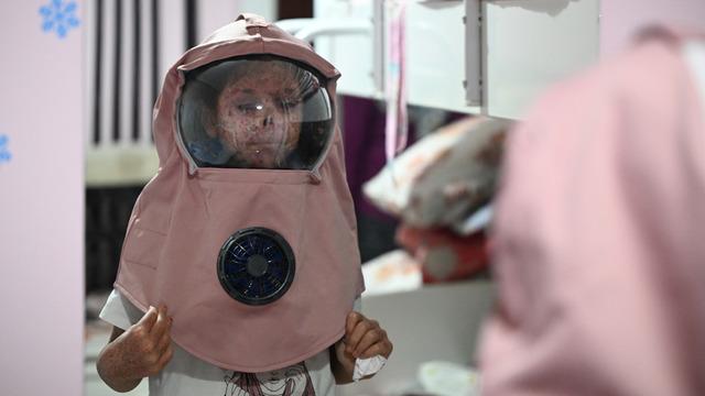 10 yaşındaki Cemile 8 yıldır güneşe hasret: Vücudu sünger gibi kendi kendini çekiyor!