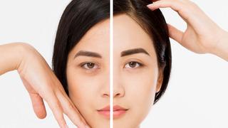 Kabusunuz olmasın! Uzman doktordan göz altı morluklarına çözüm: Göz altı morluklarından nasıl kurtulabilirim? Göz altı torbaları neden oluşur?