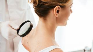Yaz aylarında dikkat! Cildiniz sinyal veriyor olabilir: Bu belirtiler cilt kanserinin habercisi...