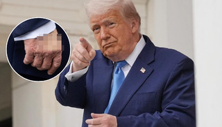Trump'ın elindeki iz olay oldu! Yama yapmış gibi...