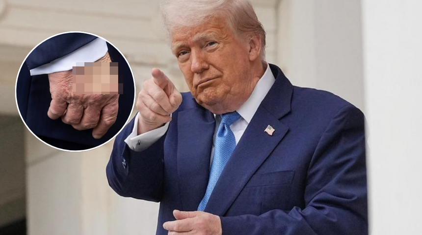 Donald Trump'ın elindeki iz olay oldu! Yama yapmış gibi...