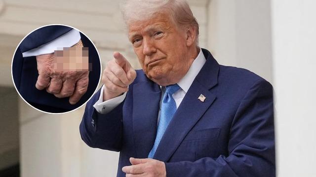 Donald Trump'ın elindeki iz olay oldu! Yama yapmış gibi...