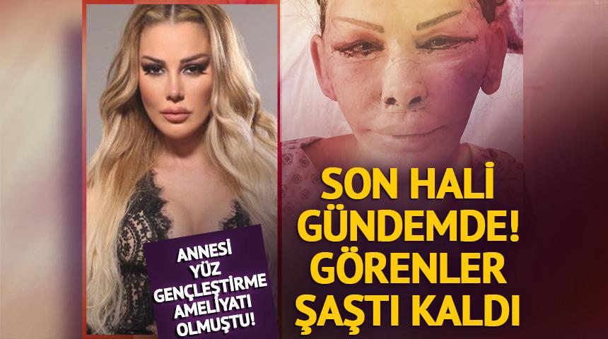 Annesi yüz gençleştirme ameliyatı olmuştu! Son halini doktoru paylaştı! Görenler şaştı kaldı