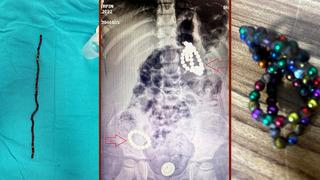 Bu oyuncak bir ölüm tuzağı! Herkesi çok şaşırtan vaka: 3 yaşında, karnında 66 adet mıknatısla aylarca yaşamış! Tehlikeye karşı uyarı: İç organlarını deliyor