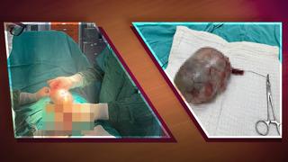 Testisten 20 santimetrelik dev tümör çıkarıldı! Uzmanlar: Hasta şikayetini gizlemiş, kitle karna ve organlara yayılmış 