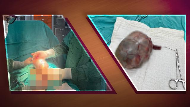 Testisten 20 santimetrelik dev tümör çıkarıldı! Uzmanlar: Hasta şikayetini gizlemiş, kitle karna ve organlara yayılmış 
