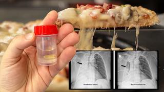 Yediği yemek az kalsın hayatından ediyordu: Sağ akciğeri tamamen kapandı! Soluk borusunu tıkadığı 5 ay sonra ortaya çıktı...