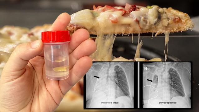 Yediği yemek az kalsın hayatından ediyordu: Sağ akciğeri tamamen kapandı! Soluk borusunu tıkadığı 5 ay sonra ortaya çıktı...