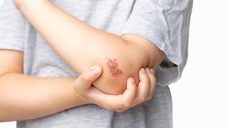 Yara kabukları neden kaşınır? Sebebi nedir?