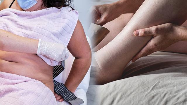 Kadınlarda sıklıkla görülüyor, kilo vermekle geçmiyor! Lipödem uyarısı: Lipödem hastalığı nedir? Uzmanından lipödem hastalarına özel tavsiyeler...