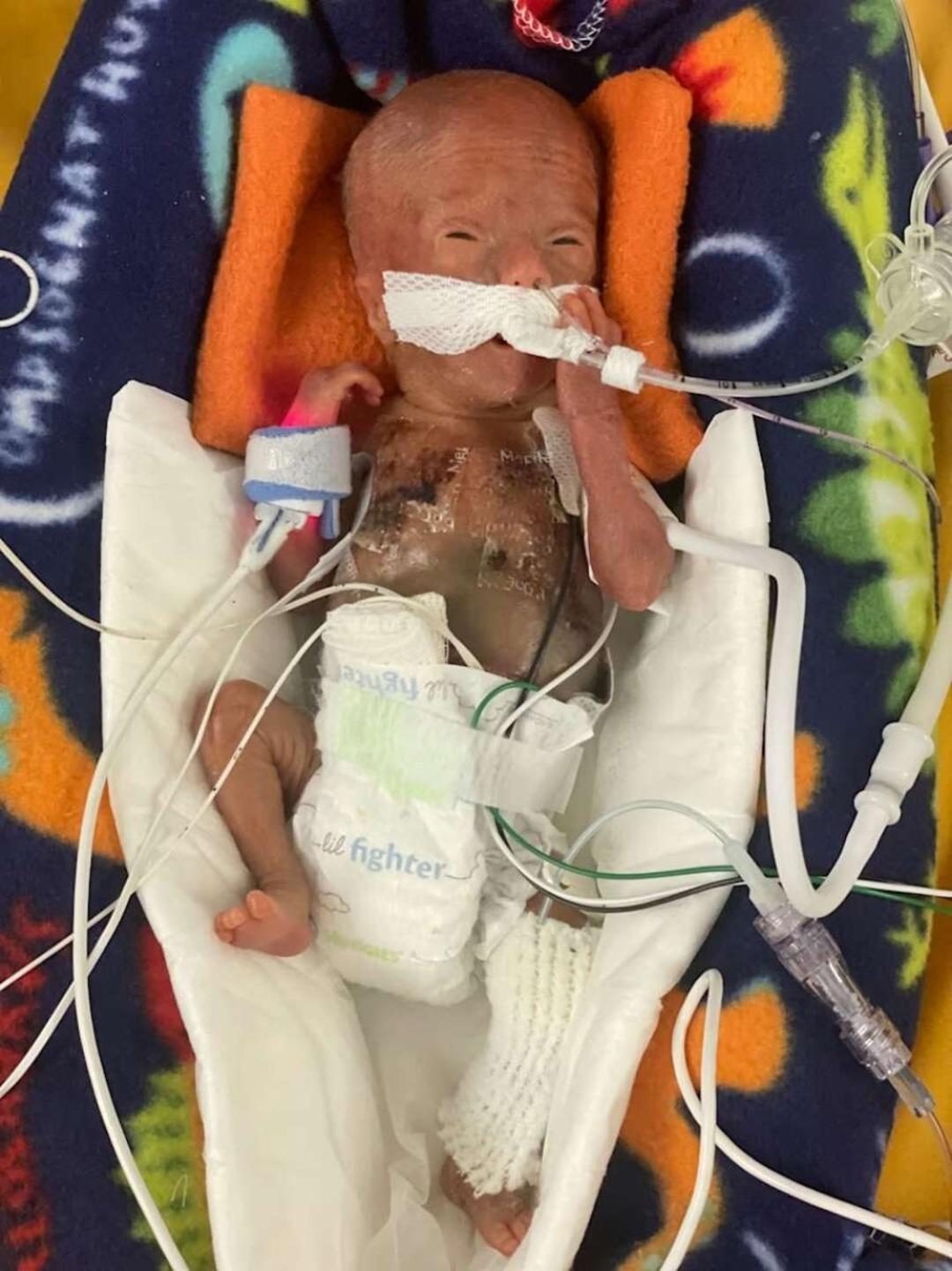 280 gram doğdu, doktorlar yaşamaz dedi! Minik bedeniyle rekor kırdı! Dünyanın en prematüre bebeği... 1