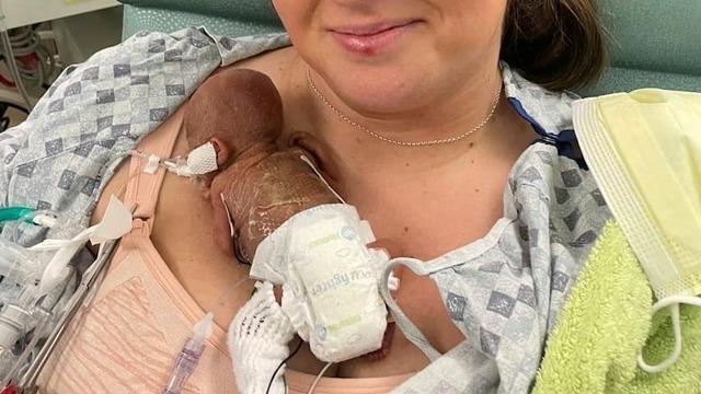 280 gram doğdu, doktorlar yaşamaz dedi! Minik bedeniyle rekor kırdı! Dünyanın en prematüre bebeği...