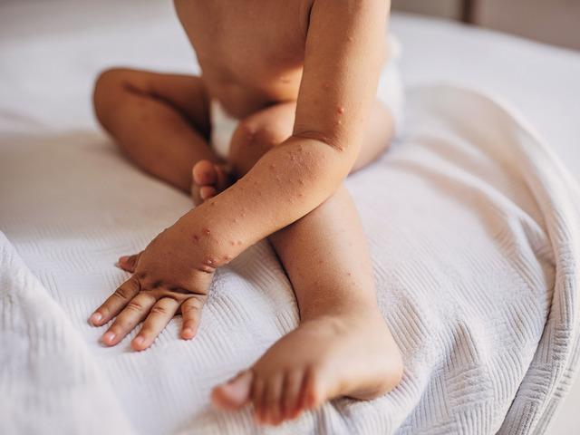 Küçük ellerde büyük rahatsızlık: El-ayak-ağız hastalığı!