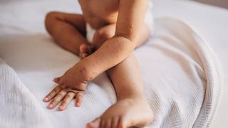 Küçük ellerde büyük rahatsızlık: El-ayak-ağız hastalığı!