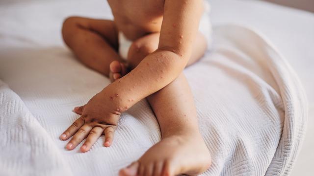 Küçük ellerde büyük rahatsızlık: El-ayak-ağız hastalığı!