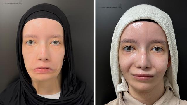 23 yıl sonra ilk kez gülümsedi! Türkiye'de bir ilk: 100 bin doğumda 1 görülen nadir hastalık: Mimikleri olmadan doğmuştu! Moebius sendromu nedir?
