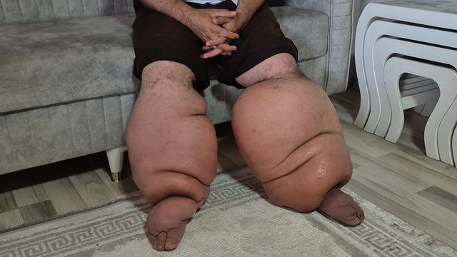 15 yıl önce hayatı geri dönülmez şekilde değişti: Yüksek ateşle gittiği hastanede, yürüyemez hale geldi... 